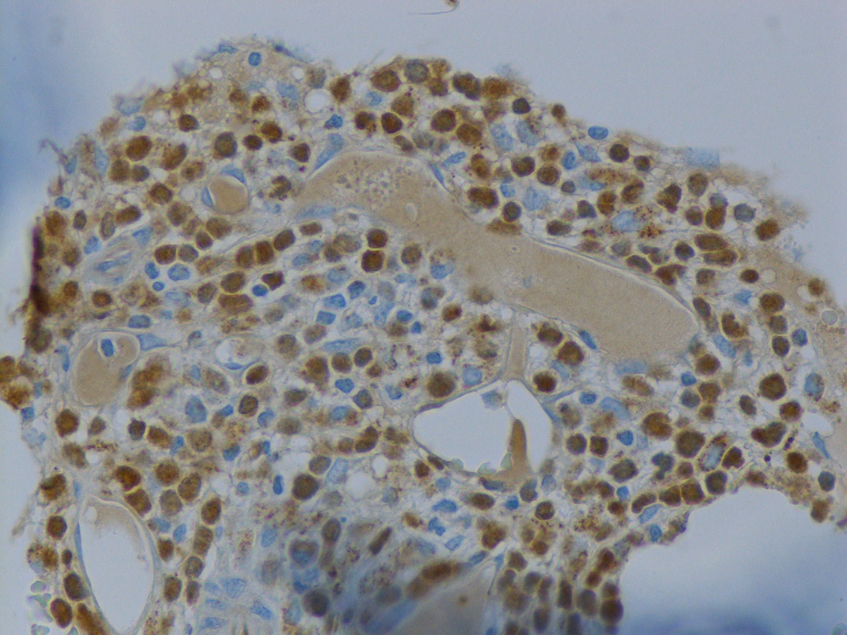 Bone marrow biopsy: TdT
